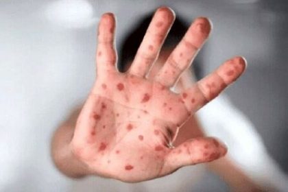 First Suspected Case of Monkeypox in the North of the Country